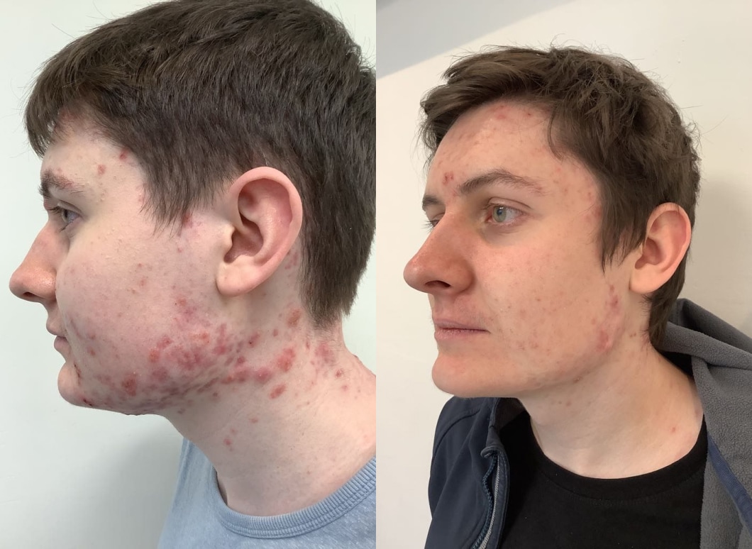 Acne | Types of Acne | Causes & Treatment – Este Medical Group